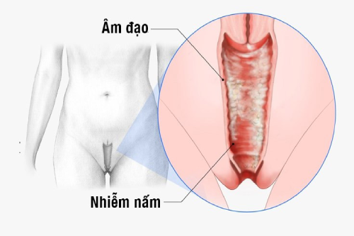 6 Dấu Hiệu Nhận Biết Cô Bé Có Khả Năng Bị Viêm Nấm Âm Đạo 6 Dấu Hiệu Nhận Biết Cô Bé Có Khả Năng Bị Viêm Nấm Âm Đạo