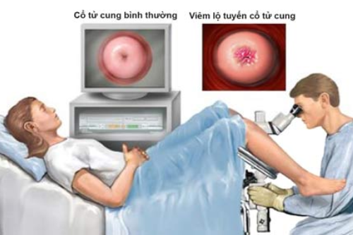 Biểu Hiện Viêm Lộ Tuyến Cổ Tử Cung Nữ Giới Đa Khoa Tây Nguyên Gia Lai 