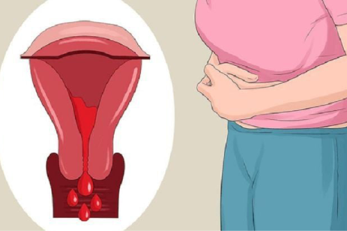 Chị Em Bị Viêm Âm Đạo Có Gây Chảy Máu Không?