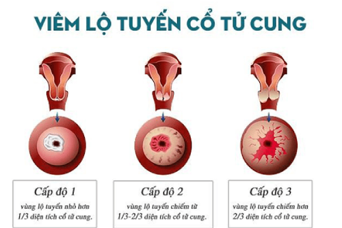 Chi Phí Chữa Viêm Lộ Tuyến Cổ Tử Cung Pleiku Gia Lai