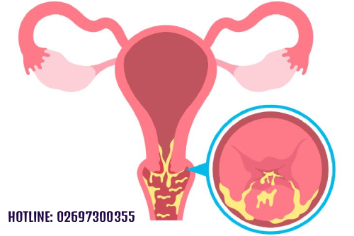 Hướng Dẫn Cách Nhận Bít Viêm Lộ Tuyến Sớm Cho Phụ Nữ