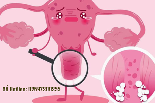 Ngứa Âm Đạo Nữ Giới Có Sao Không Pleiku Gia Lai?