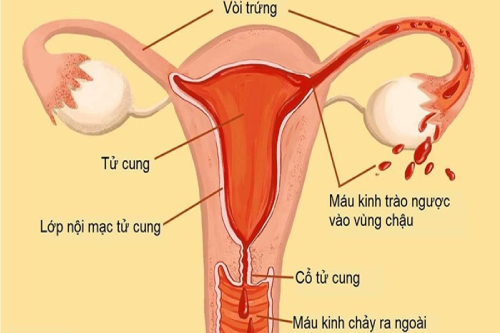 Nguyên Nhân Dẫn Đến Viêm Nội Mạc Cổ Tử Cung Tại Gia Lai