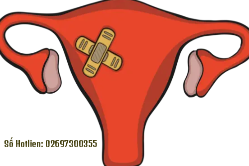 Nguyên Nhân Và Cách Điều Trị Mụn Âm Đạo Hiệu Qủa An Toàn Cho Nữ Giới