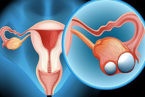 Nguyên Nhân Và Triệu Chứng Viêm Phần Phụ Ở Nữ Giới