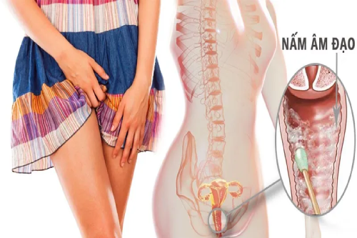 Những Dấu Hiệu Nhận Biết Viêm Nấm Âm Đạo Nữ Giới Những Dấu Hiệu Nhận Biết Viêm Nấm Âm Đạo Nữ Giới