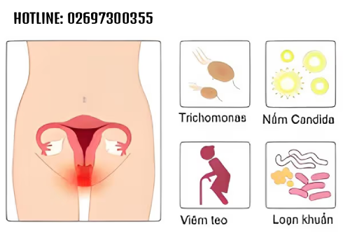 nu-gioi-bi-viem-vung-kin-co-nguy-hiem-khong