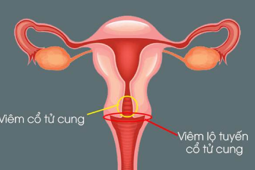 Triệu Chứng Nhận Biết Viêm Cổ Tử Cung Nữ Giới Pleiku